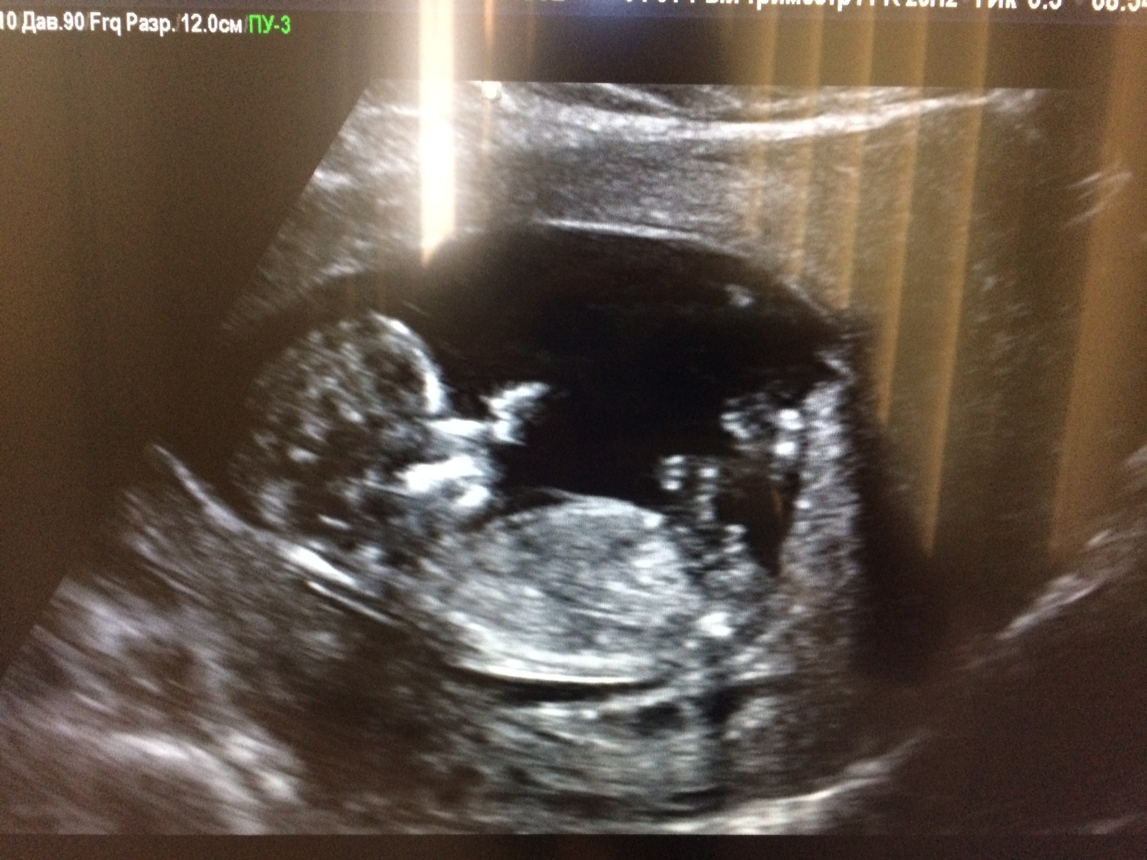 УЗИ 12 недель беременности скрининг мальчик