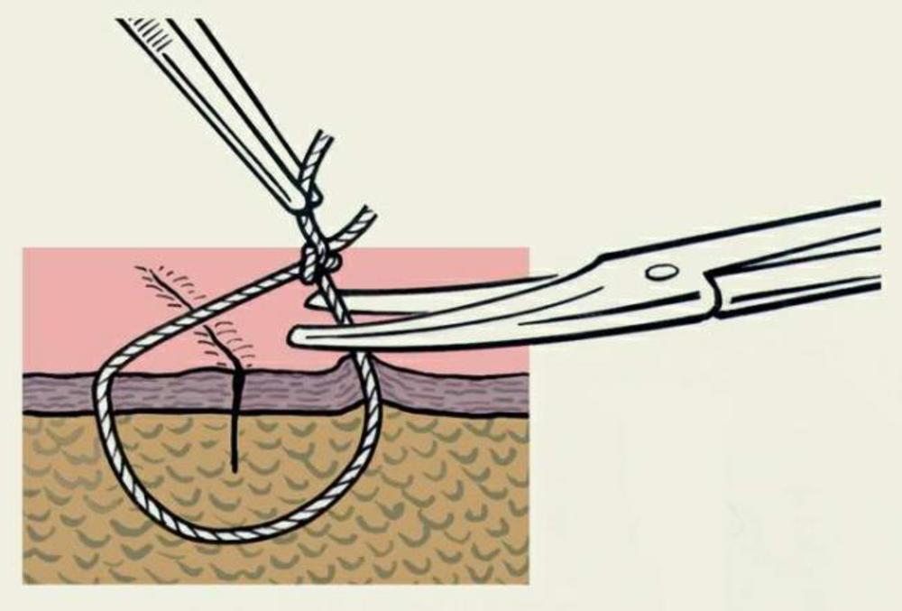 Чем можно обрабатывать швы после операции. Техника снятия узловых швов. Узловой хирургический шов. Техника снятия швов с раны.