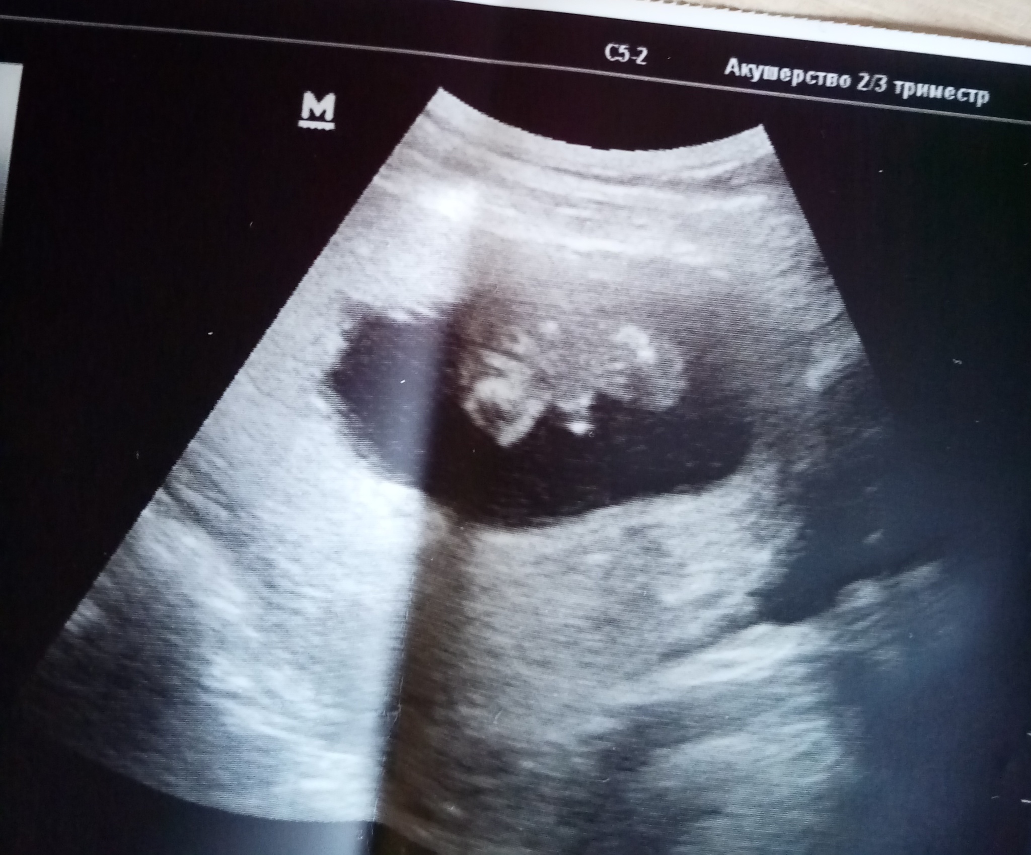 УЗИ 16 недель беременности мальчик