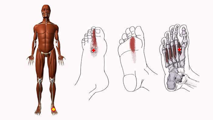 Триггерные точки стопы. Триггерные точки на ступне. Триггерные точки на подошве стопы. Триггерные точки мышц стопы.