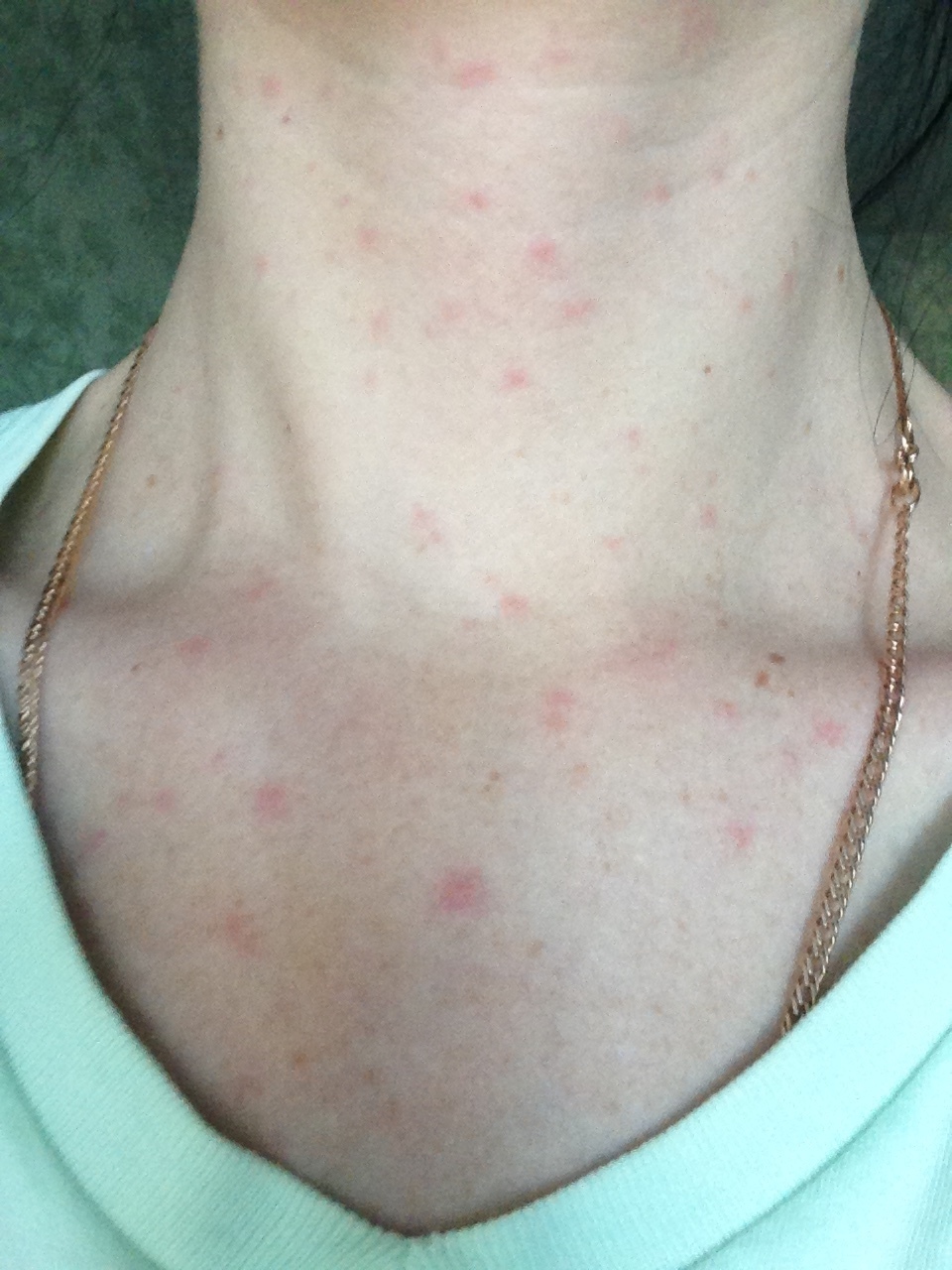Аллергические реакции и кожная сыпь