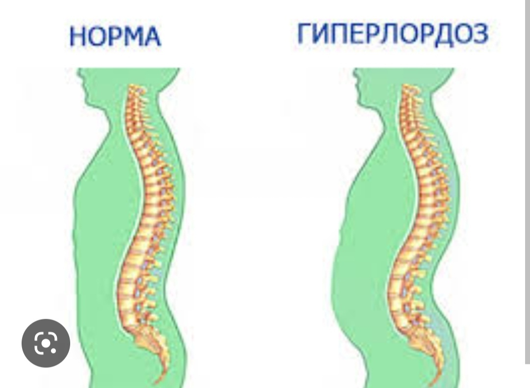 Гиперлордоз