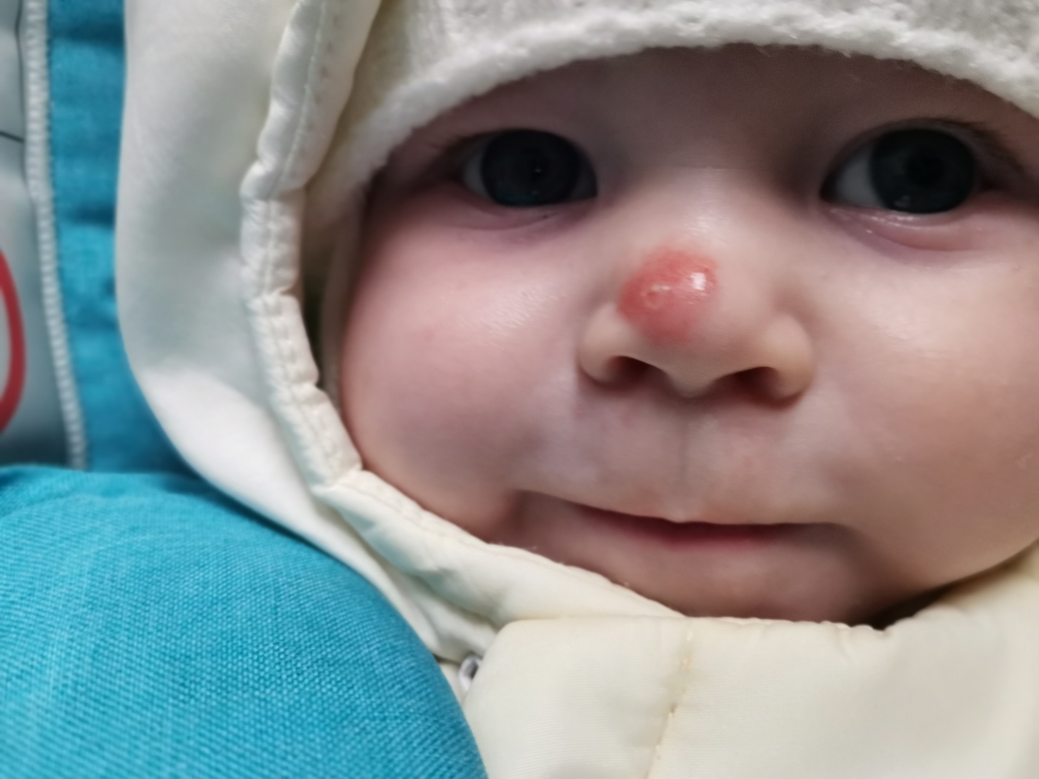 Красный нос у новорожденного