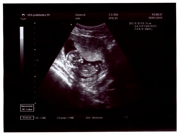 Беременность 12 3. УЗИ 12 недель беременности. УЗИ беременных на 12 неделе беременности. УЗИ 13 недель беременности. Снимки УЗИ беременности 12 недель.