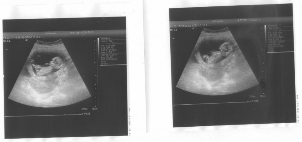 1 й скрининг при беременности фото