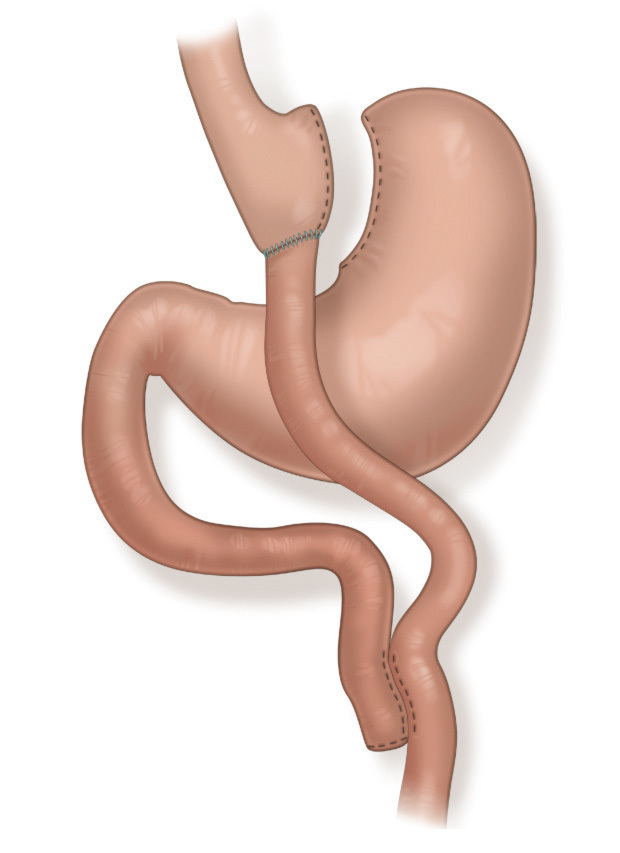 Шунтирование желудка. Желудочное шунтирование, Roux-en-y. Гастрошунтирование гастрошунтирование желудка. Гастрошунтирование желудка операция. Лапароскопическое гастрошунтирование (gastric-Bypass)..