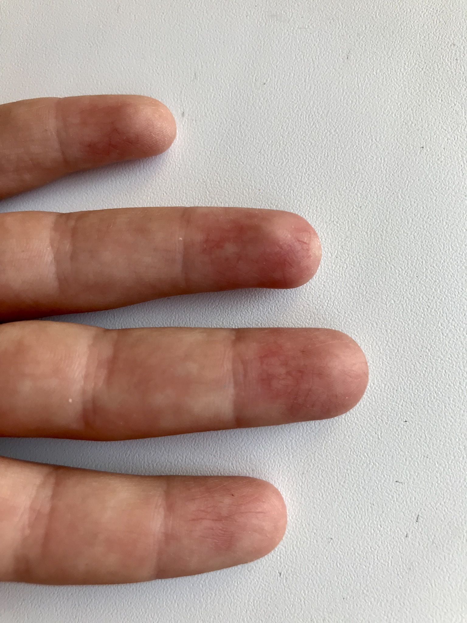 Припухлость на суставе пальца. Пальчик форум. Пальчик форум. Ревматоидный артрит пальцев рук. Ревматоидный артрит руки.