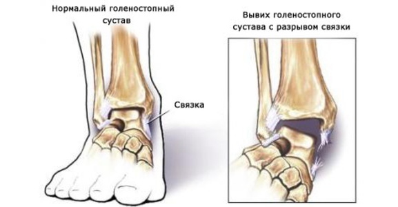 Перелом наружной лодыжки карта вызова скорой помощи