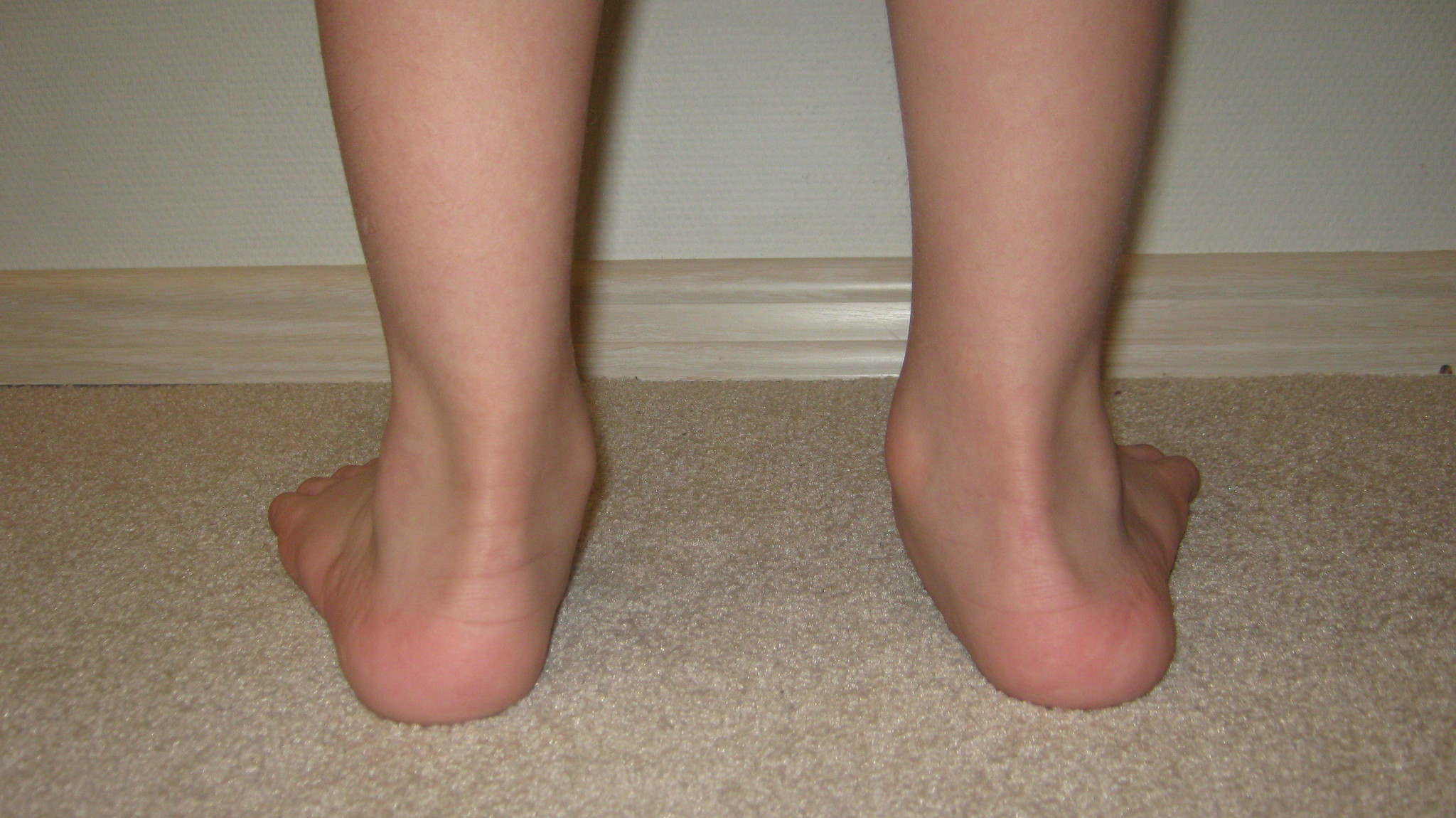 плоскостопие фото ног