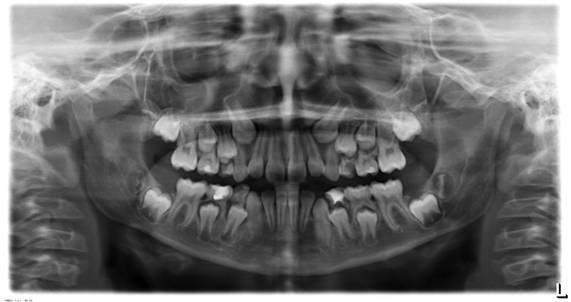 Фото зубов у детей рентген